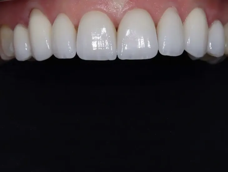 Feldspathic Veneers